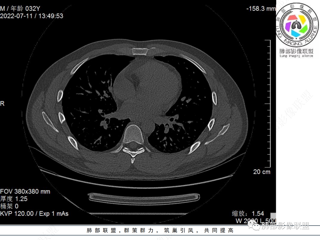 【病例】支气管腔内结节灶，你能想到哪些病变？-20
