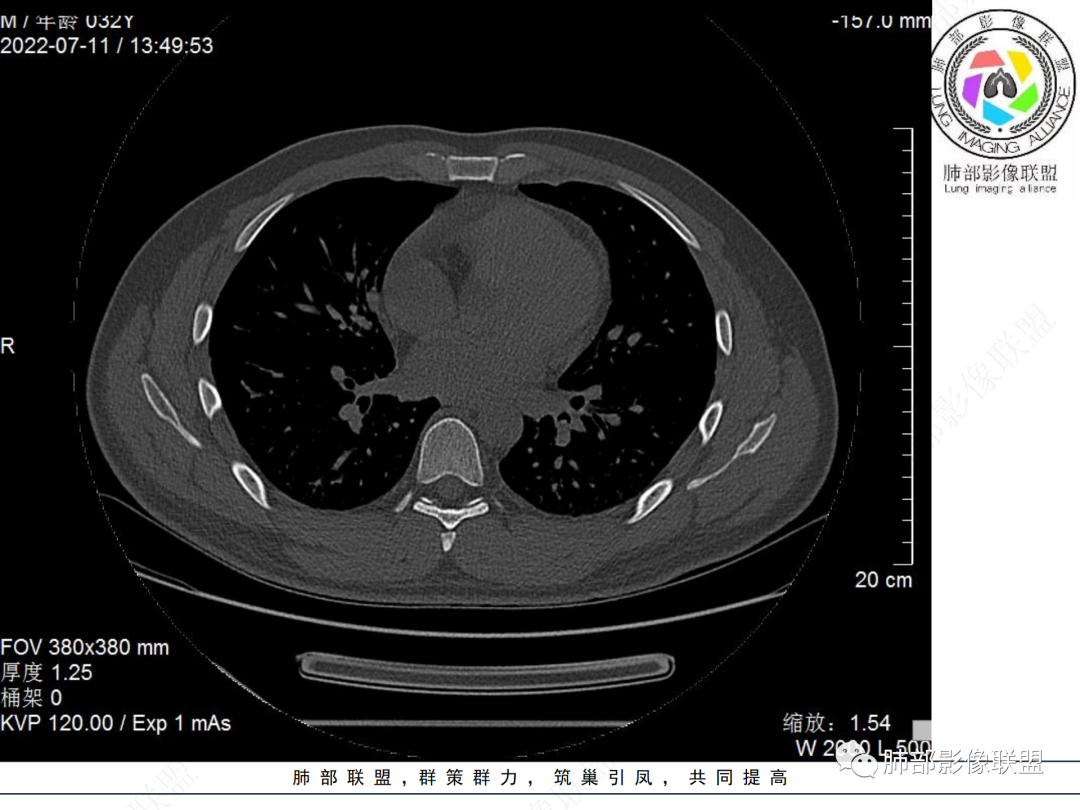 【病例】支气管腔内结节灶，你能想到哪些病变？-21