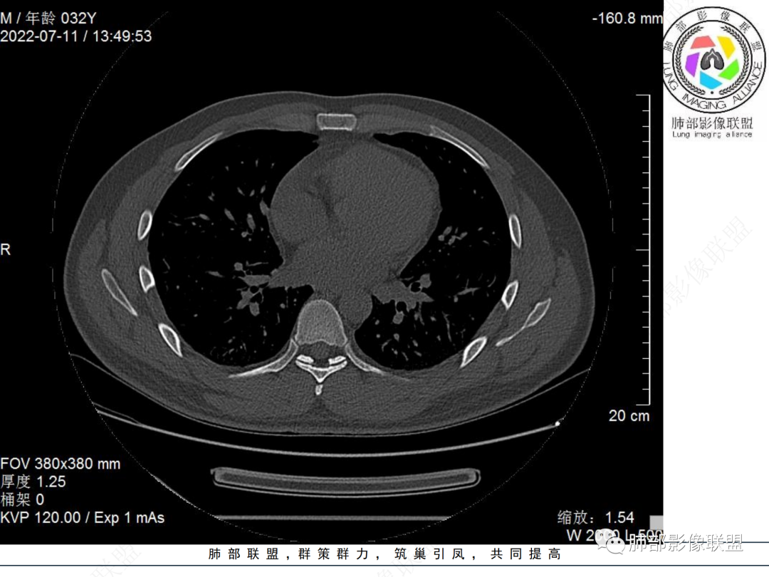 【病例】支气管腔内结节灶，你能想到哪些病变？-22