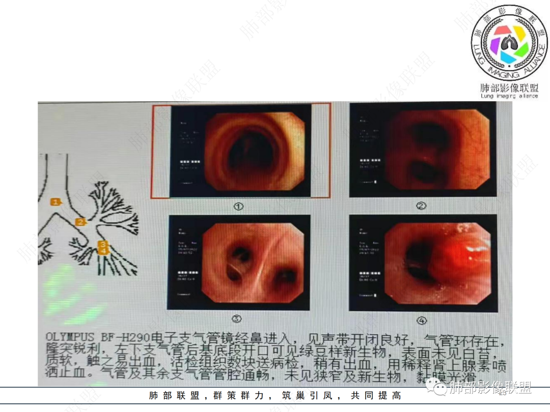 【病例】支气管腔内结节灶，你能想到哪些病变？-23