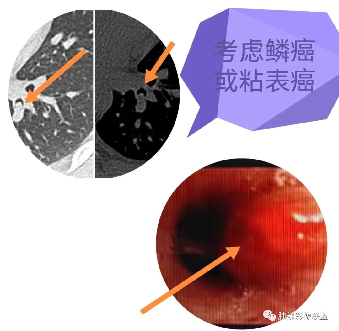 【病例】支气管腔内结节灶，你能想到哪些病变？-27