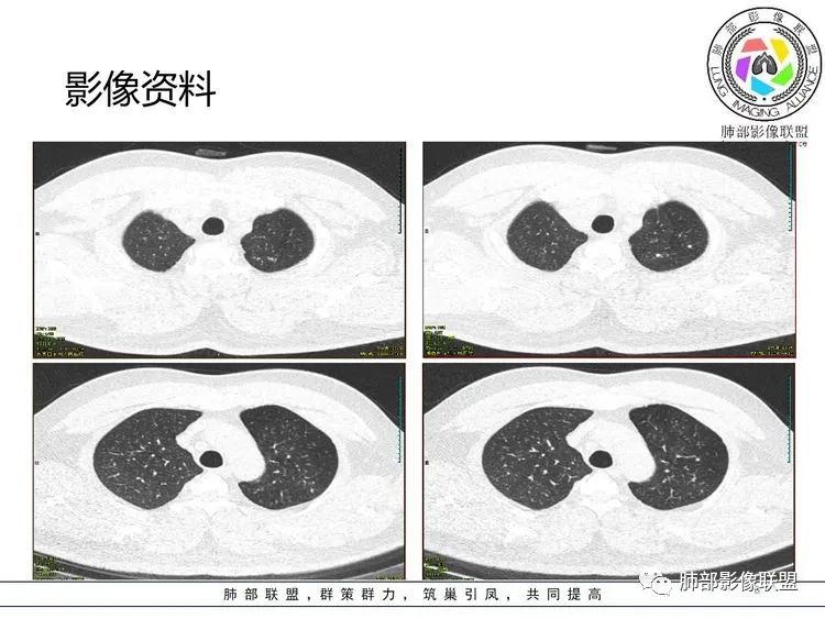 【病例】支原体肺炎-6