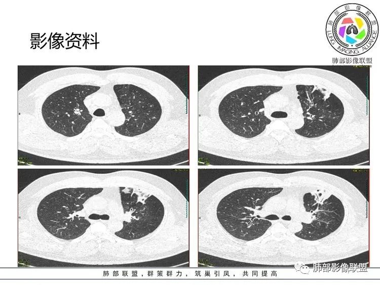 【病例】支原体肺炎-7