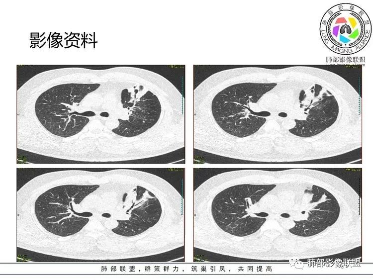 【病例】支原体肺炎-8