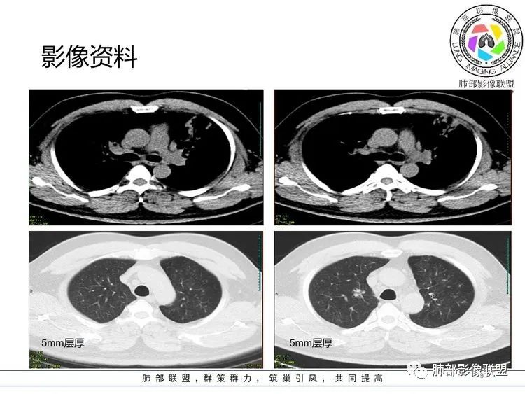 【病例】支原体肺炎-9