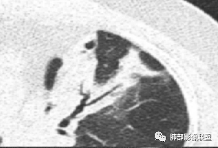 【病例】支原体肺炎-12