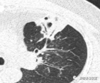 【病例】支原体肺炎-13