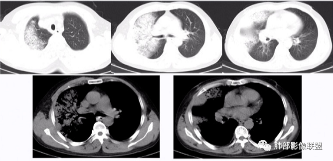【病例】支原体肺炎-17