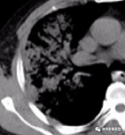【病例】支原体肺炎-18
