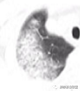 【病例】支原体肺炎-19