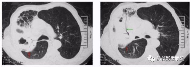 【病例】支原体肺炎-21