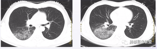 【病例】支原体肺炎-22