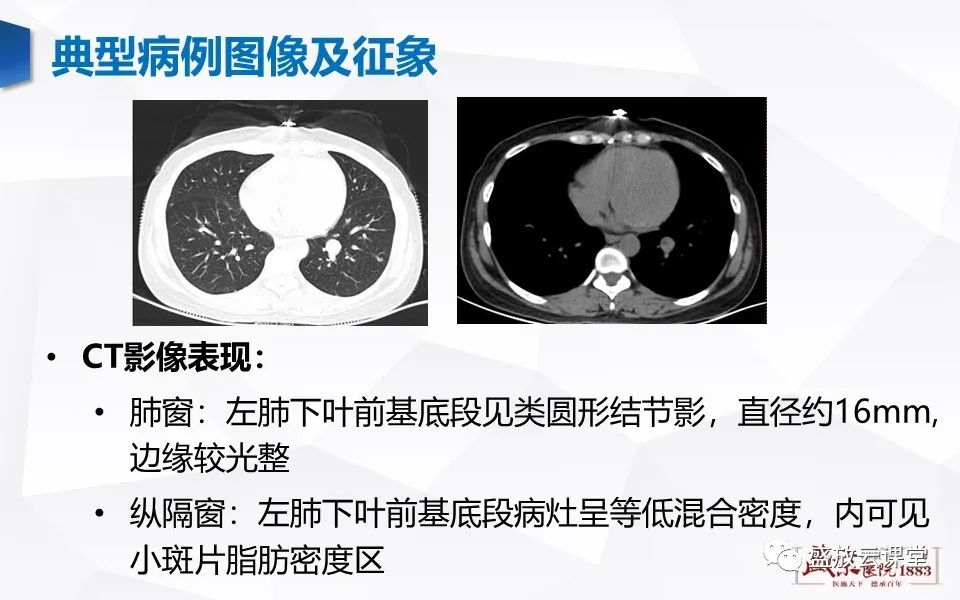 【病例】肺错构瘤 VS 肺硬化性血管瘤-4