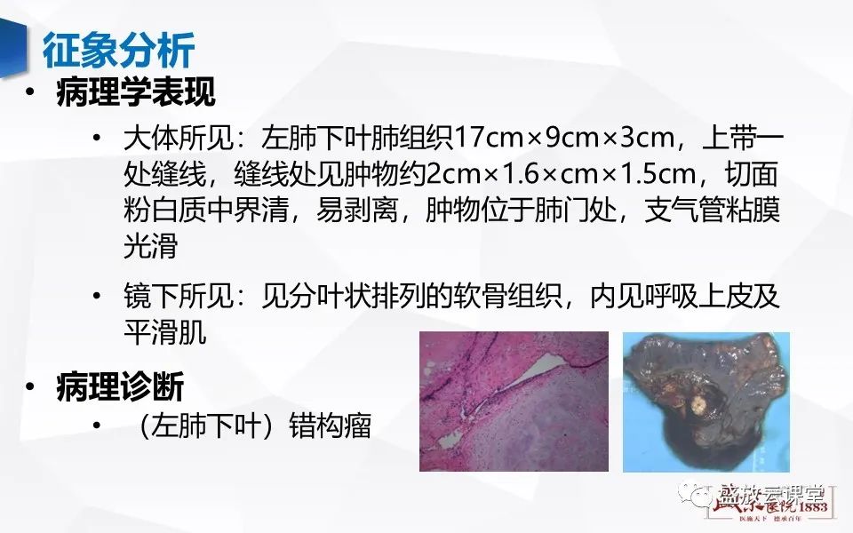【病例】肺错构瘤 VS 肺硬化性血管瘤-6