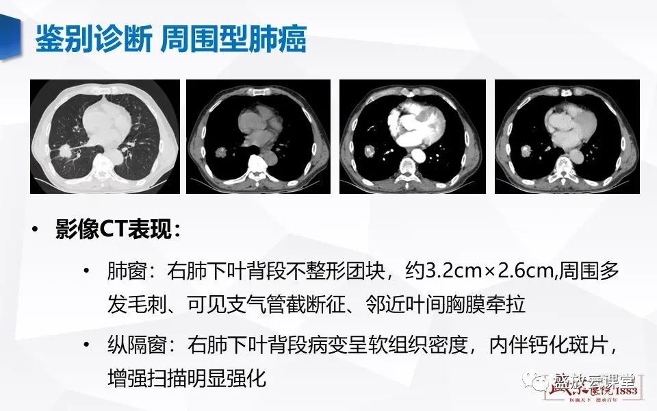 【病例】肺错构瘤 VS 肺硬化性血管瘤-12