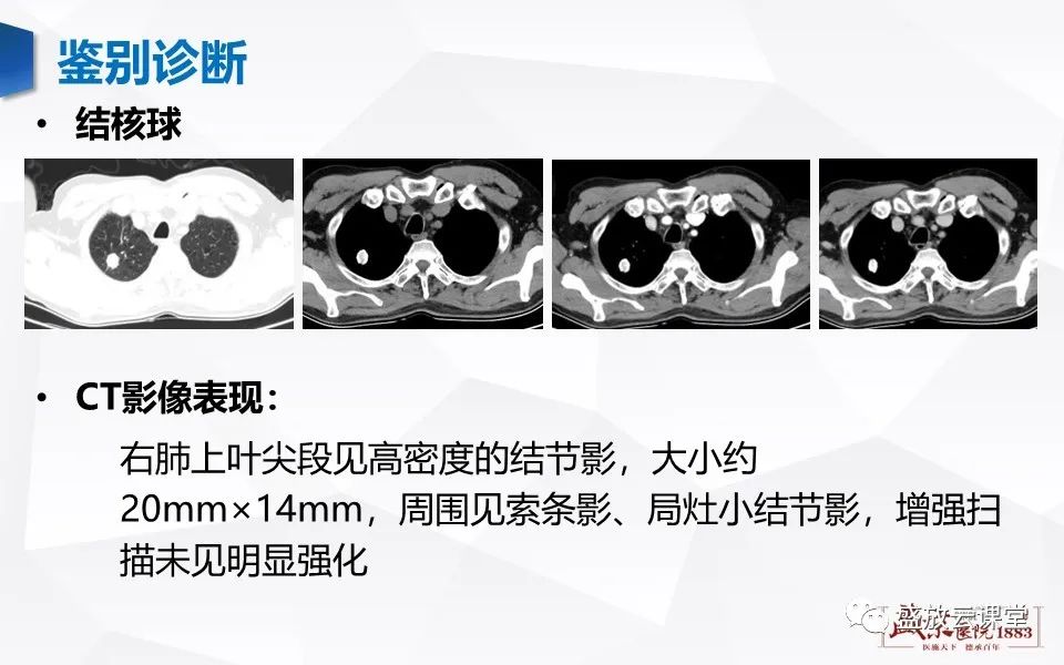 【病例】肺错构瘤 VS 肺硬化性血管瘤-15