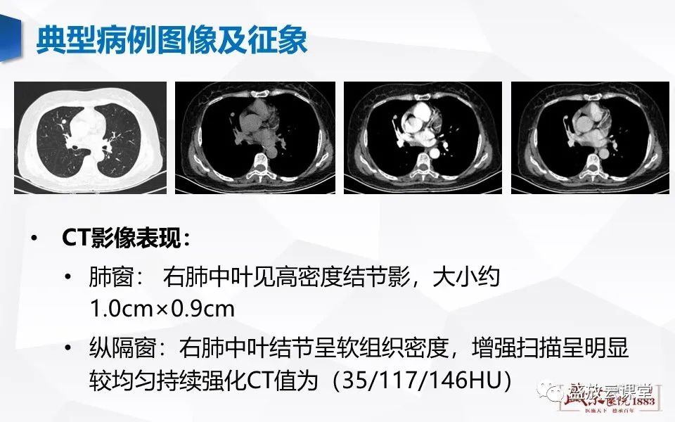 【病例】肺错构瘤 VS 肺硬化性血管瘤-21