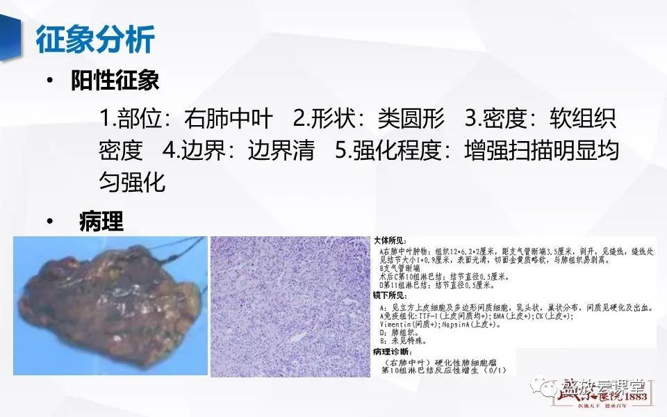 【病例】肺错构瘤 VS 肺硬化性血管瘤-22