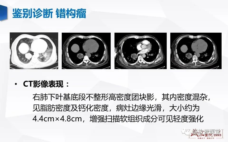 【病例】肺错构瘤 VS 肺硬化性血管瘤-26