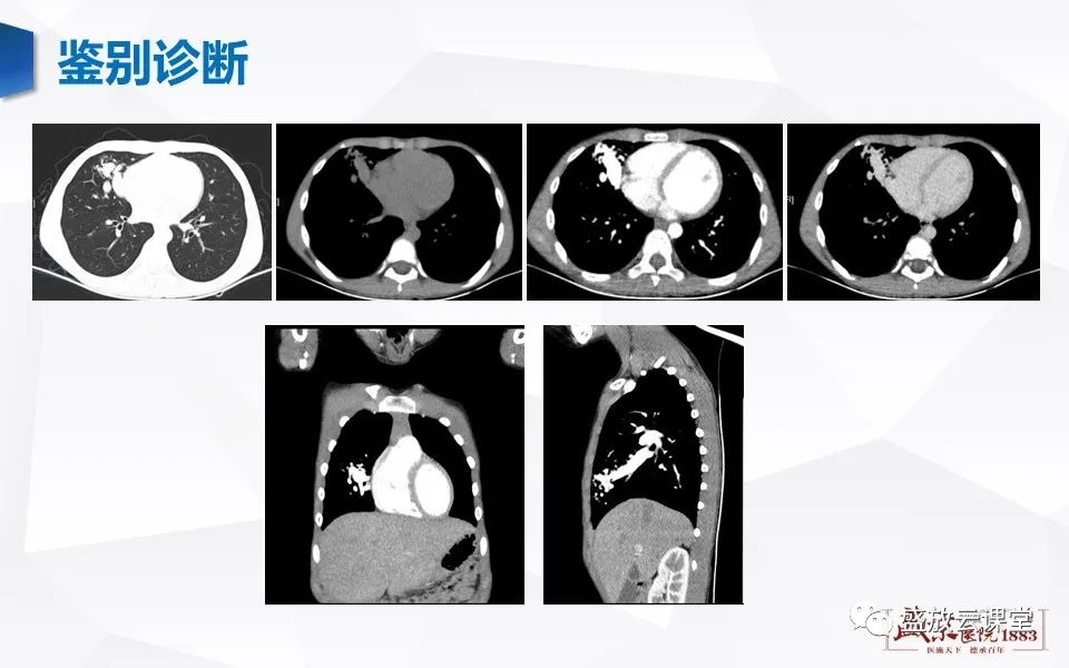 【病例】肺错构瘤 VS 肺硬化性血管瘤-28