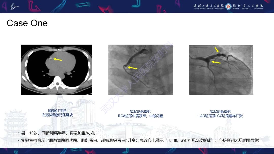 【PPT】川崎病冠状动脉病变影像诊断-2