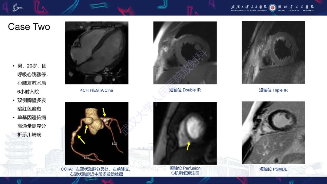 【PPT】川崎病冠状动脉病变影像诊断-4