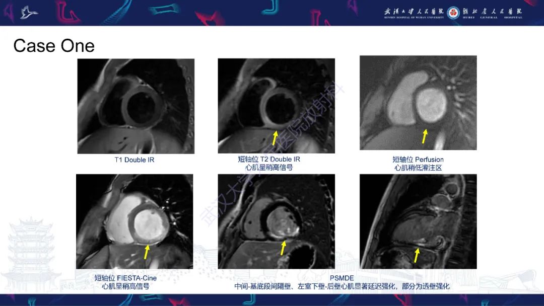 【PPT】川崎病冠状动脉病变影像诊断-3
