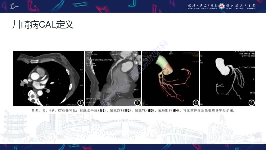 【PPT】川崎病冠状动脉病变影像诊断-10