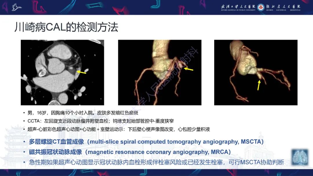 【PPT】川崎病冠状动脉病变影像诊断-16