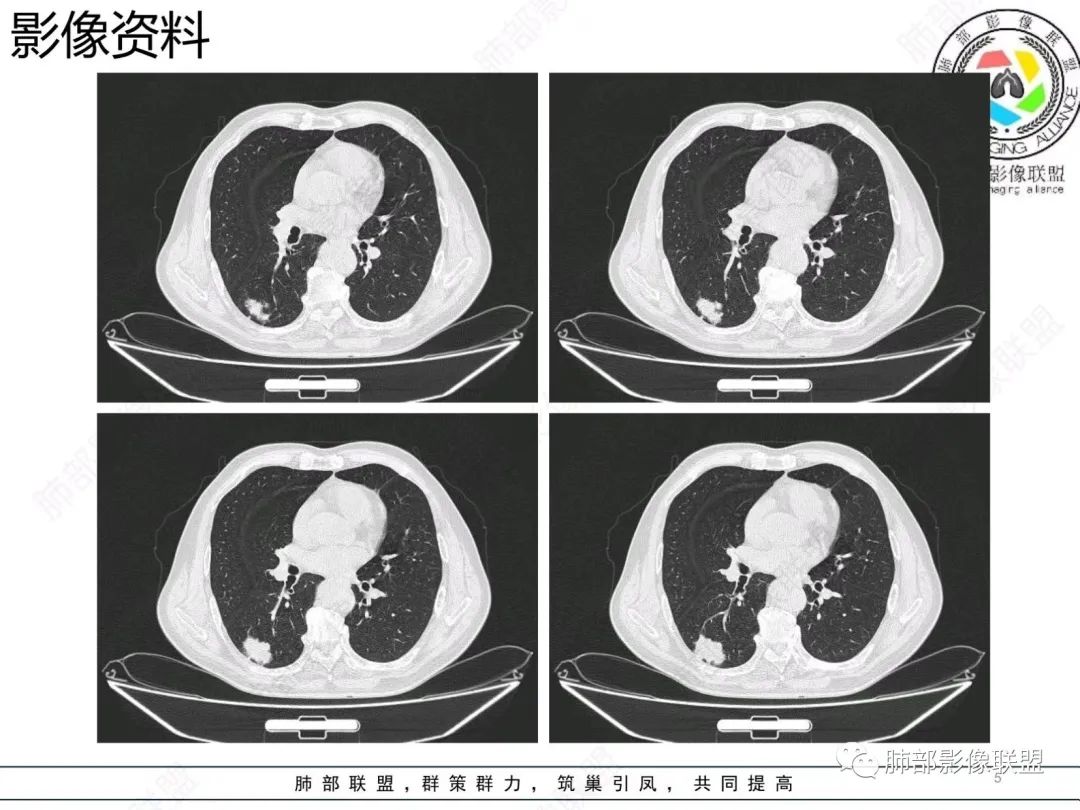 【病例】胸膜下的混合密度结节—良恶之争-5