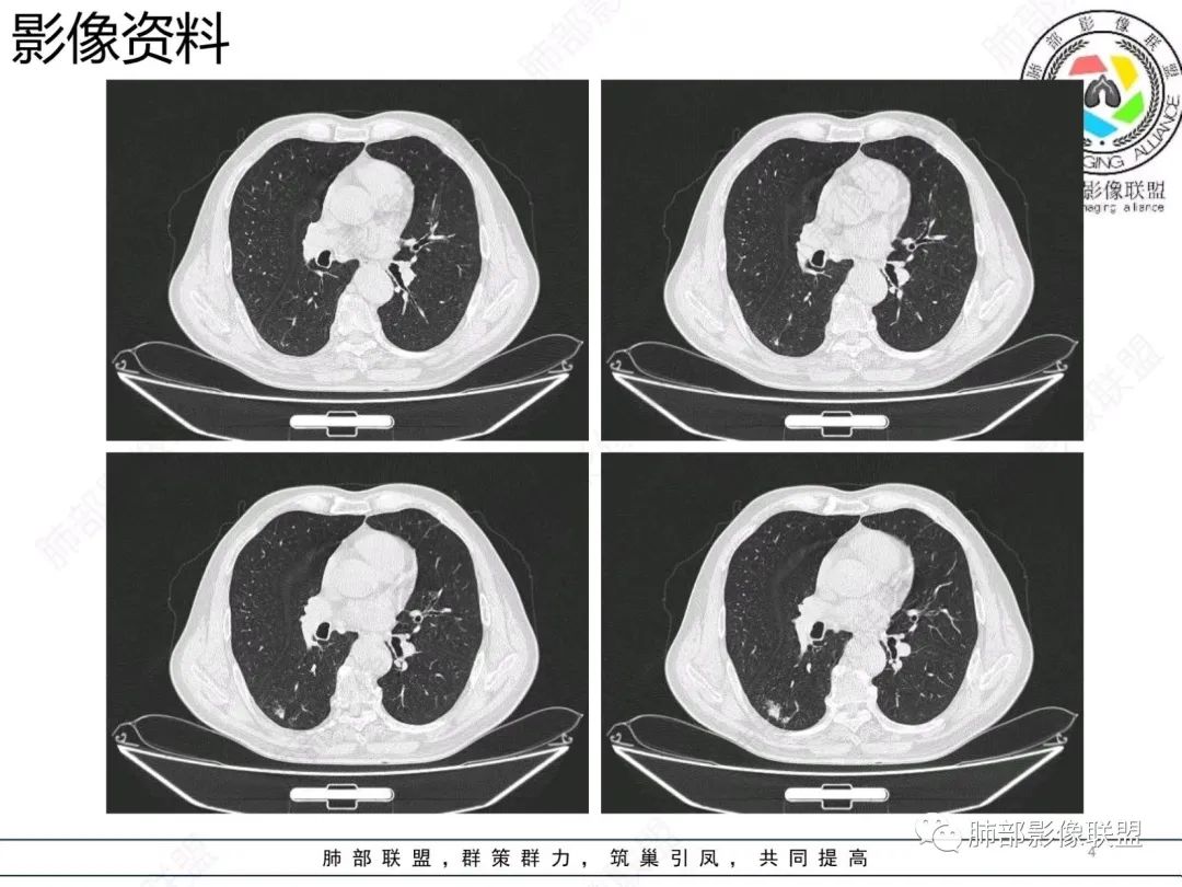 【病例】胸膜下的混合密度结节—良恶之争-4