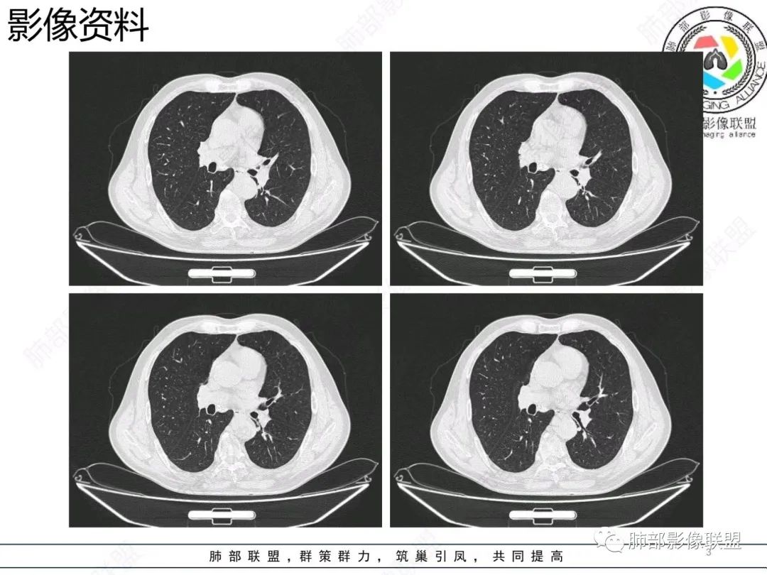 【病例】胸膜下的混合密度结节—良恶之争-3