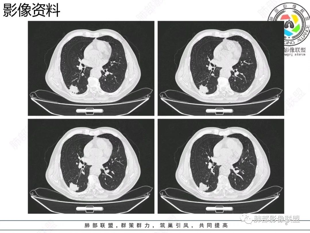 【病例】胸膜下的混合密度结节—良恶之争-6
