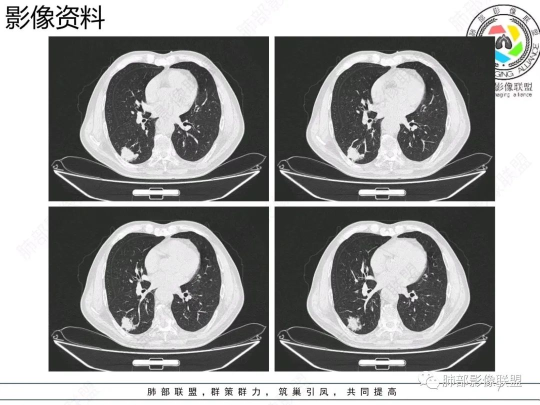 【病例】胸膜下的混合密度结节—良恶之争-7
