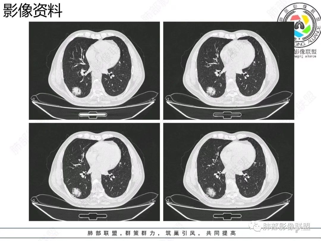【病例】胸膜下的混合密度结节—良恶之争-8