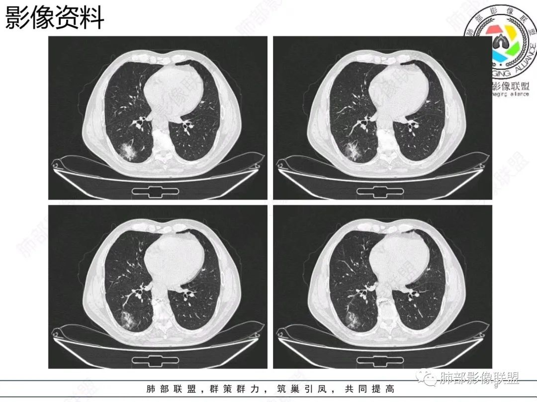 【病例】胸膜下的混合密度结节—良恶之争-9