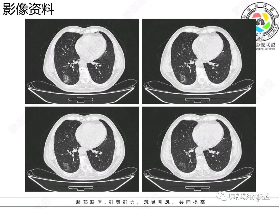 【病例】胸膜下的混合密度结节—良恶之争-10