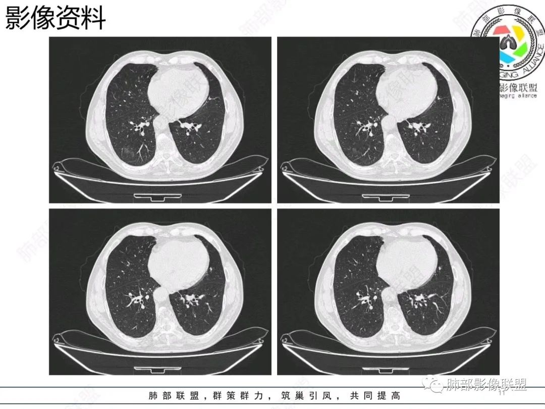 【病例】胸膜下的混合密度结节—良恶之争-11