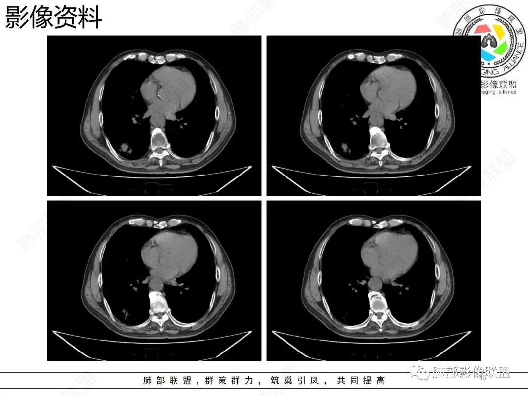 【病例】胸膜下的混合密度结节—良恶之争-15