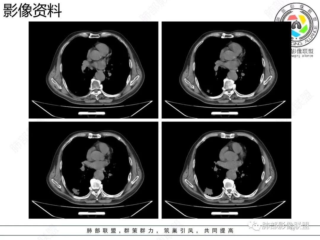 【病例】胸膜下的混合密度结节—良恶之争-13