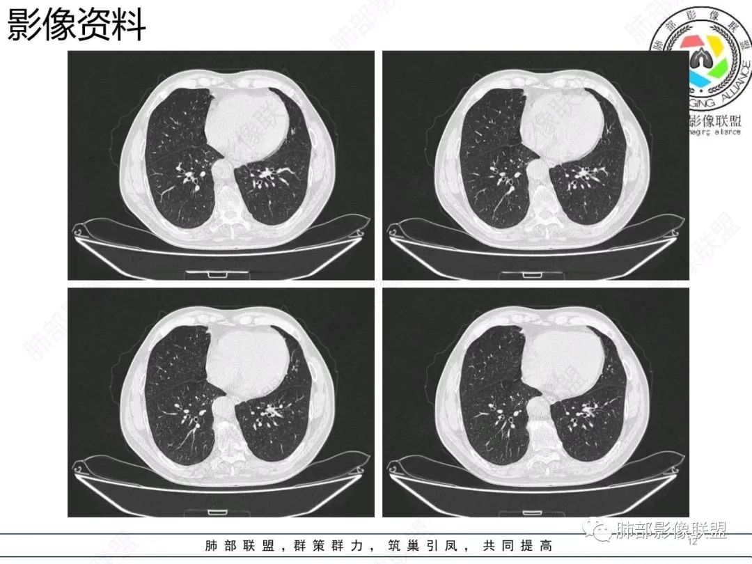 【病例】胸膜下的混合密度结节—良恶之争-12