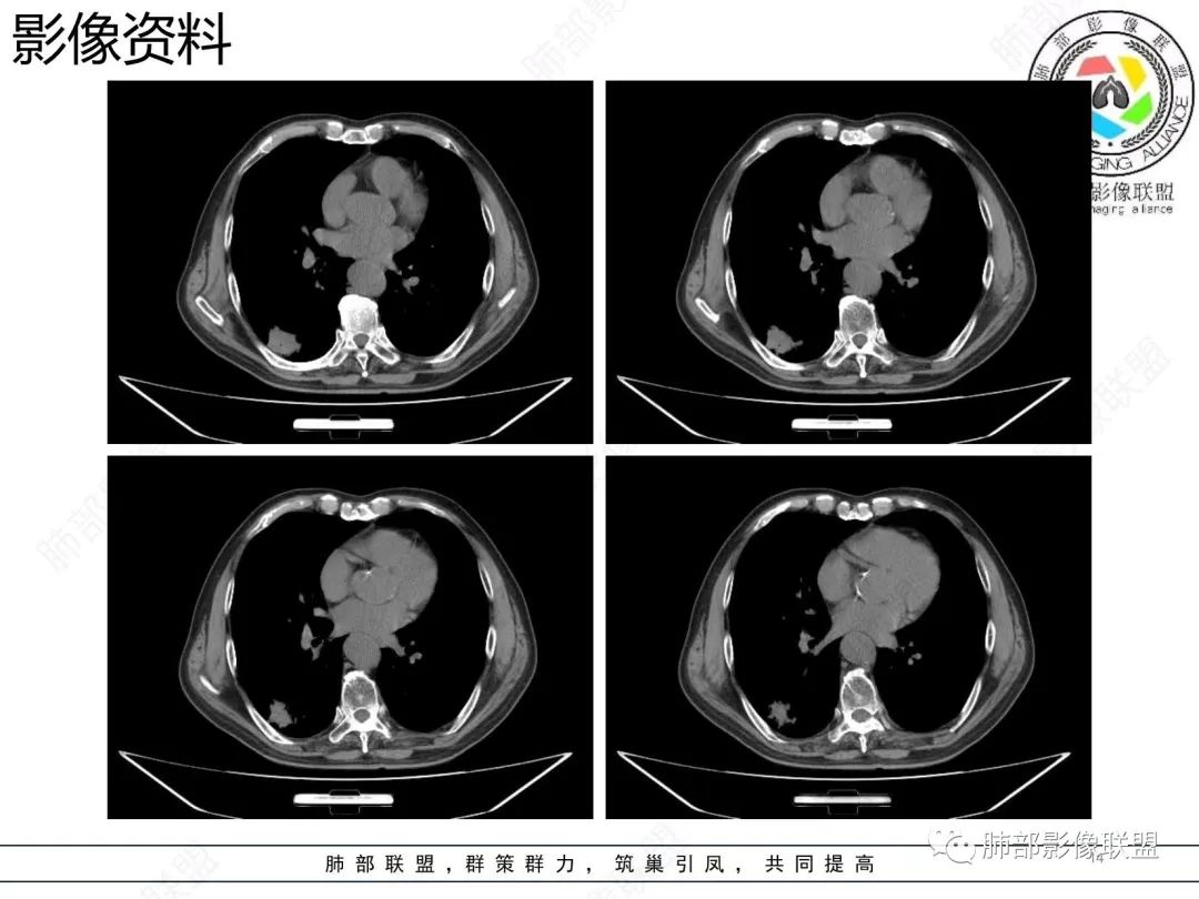 【病例】胸膜下的混合密度结节—良恶之争-14