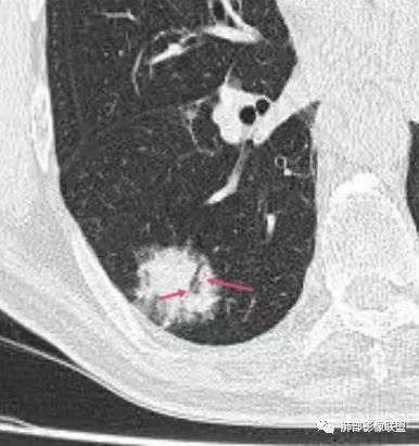 【病例】胸膜下的混合密度结节—良恶之争-18