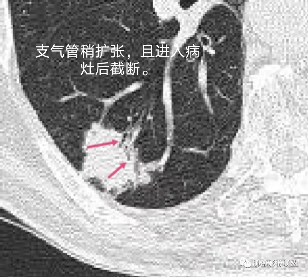 【病例】胸膜下的混合密度结节—良恶之争-17