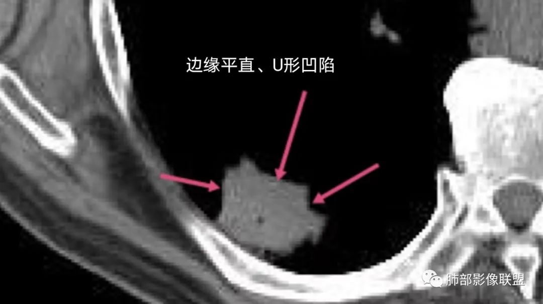 【病例】胸膜下的混合密度结节—良恶之争-19