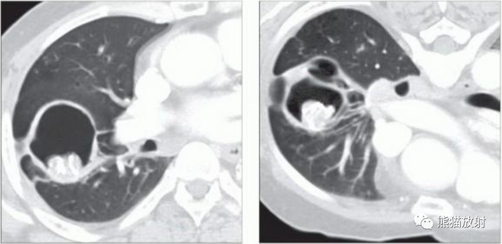 肺曲霉菌病、肺隐球菌病影像表现-1