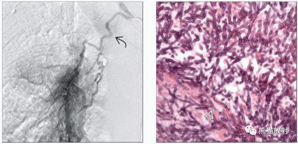肺曲霉菌病、肺隐球菌病影像表现-5