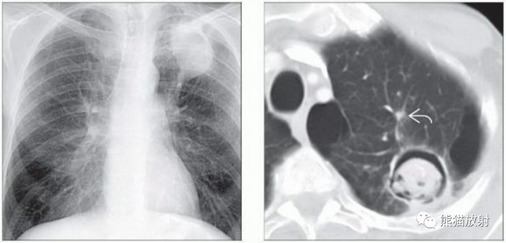 肺曲霉菌病、肺隐球菌病影像表现-3