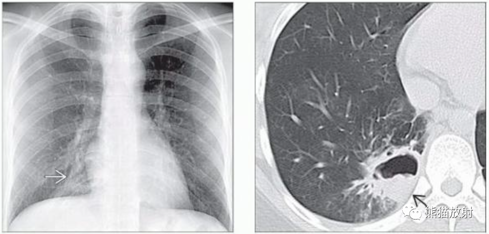 肺曲霉菌病、肺隐球菌病影像表现-4