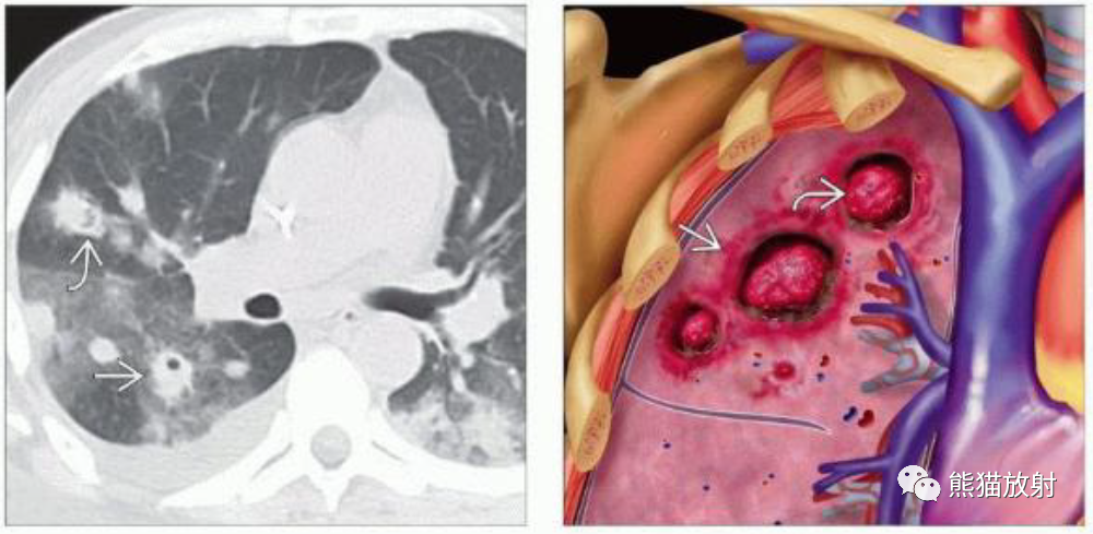 肺曲霉菌病、肺隐球菌病影像表现-2